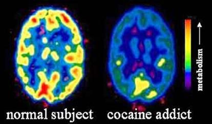 Cerebro sufre daños irreversibles cuando consumo de drogas es en etapas tempranas de la vida