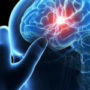 INCN realiza tratamiento efectivo para infartos cerebrales
