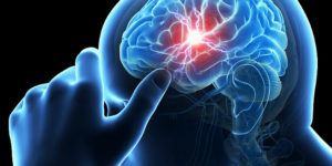 INCN realiza tratamiento efectivo para infartos cerebrales