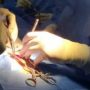 INCN coloca primer neuromodulador medular a paciente con dolor crónico